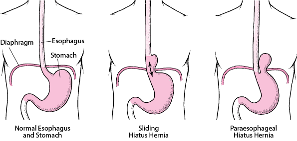 hiatal-hernia